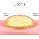 Lipoma