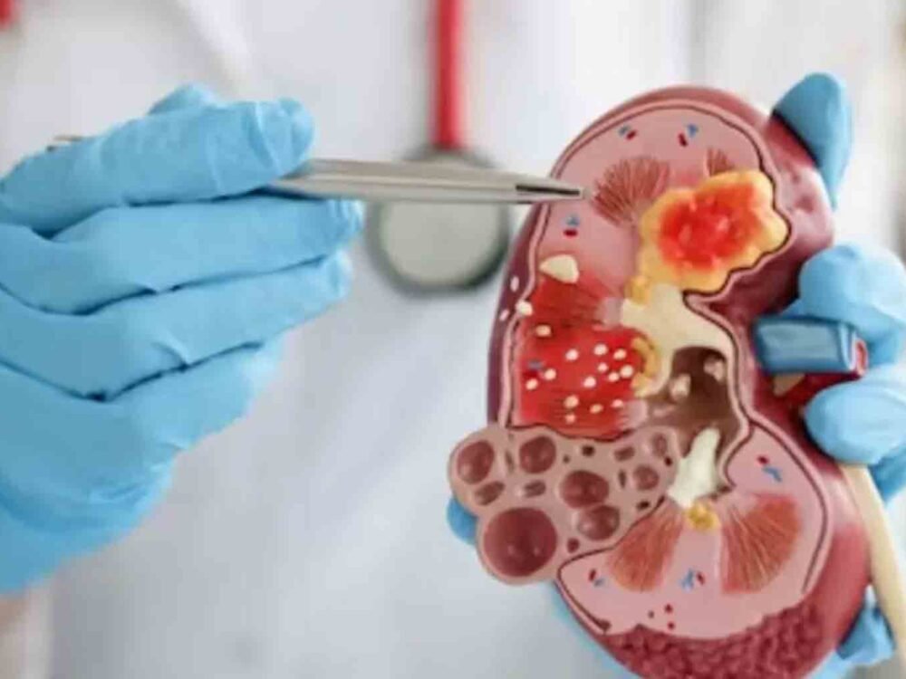 Rising Kidney Disease Deaths in Telangana