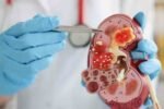 Rising Kidney Disease Deaths in Telangana